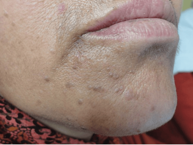 皇冠信用網在哪里开通_脖子上长出的小肉粒皇冠信用網在哪里开通，能揪吗？